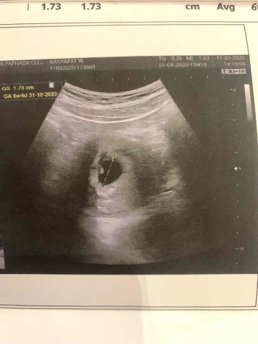 จะท้องลมมั้ยคะ