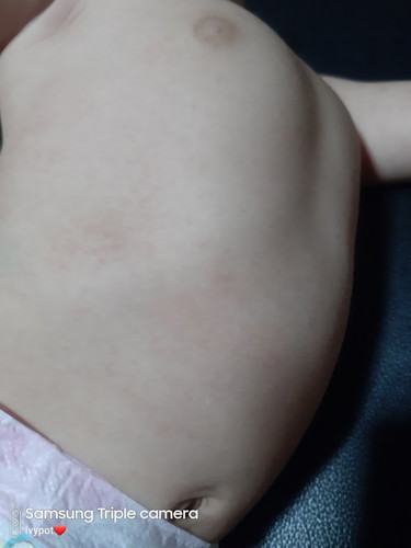 rashes, red patches