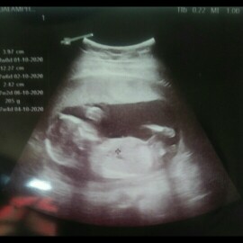 ประสบการณ์ แท้ง5ครั้ง ทำให้รู้สึกกลัว