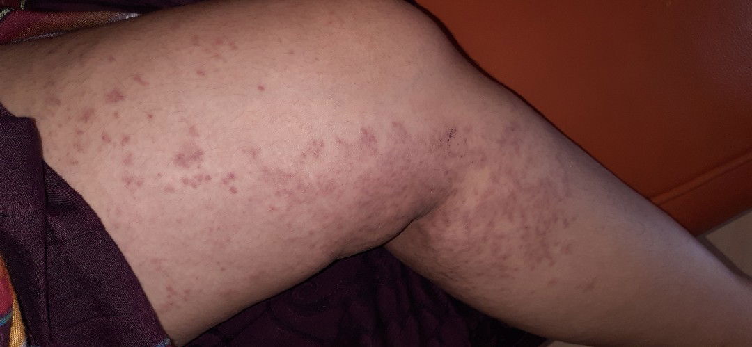 bekas gatal saat hamil