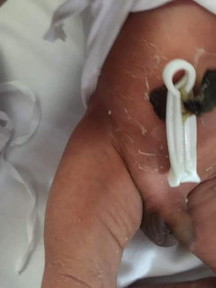 undescended testicles or not?