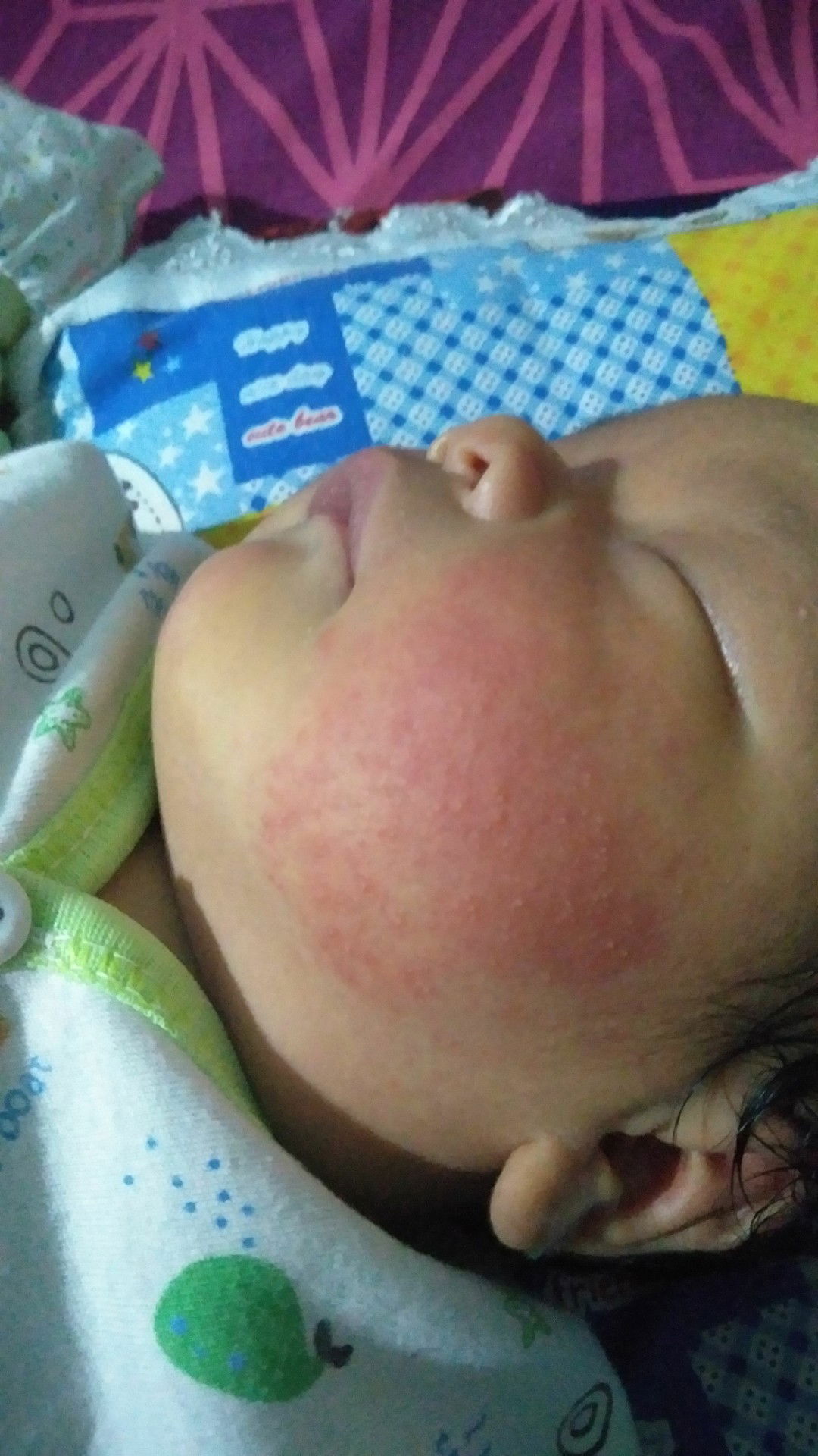 bintik merah di pipi