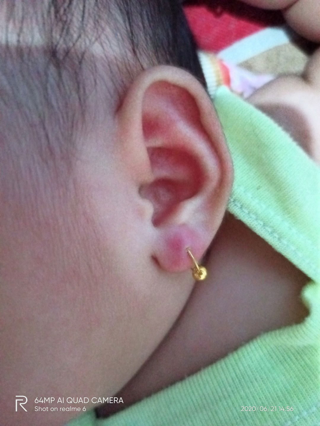 kuping merah setelah ditindik