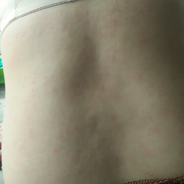 เป็นผื่นแบบนี้อัตรายกับลุกไม่ค่ะ