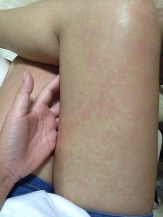 แม่คะขึ้นผื่นแบบนี้เป็นอะไรคะ