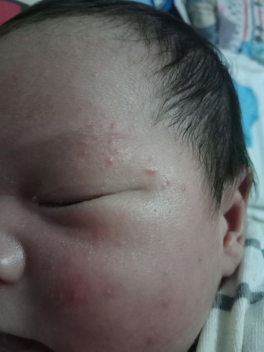 rash