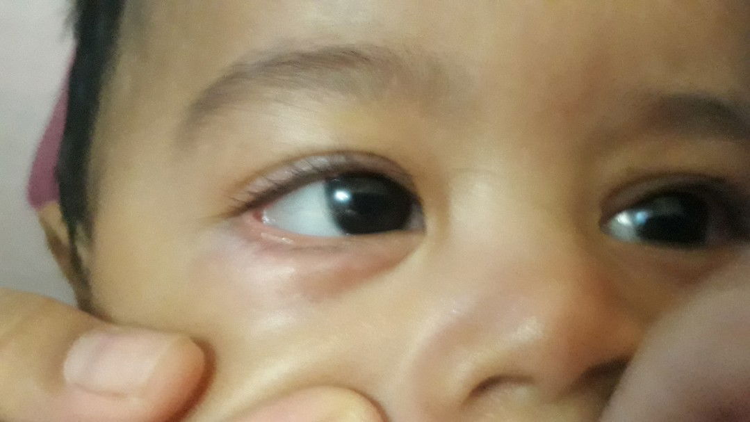 bawah mata anak bintik2 merah