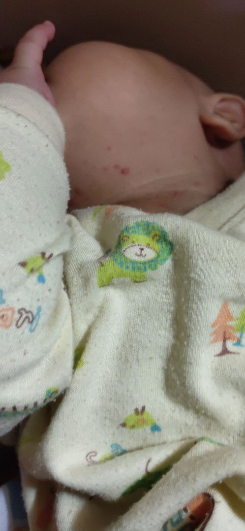 cacar atau ruam biasa..