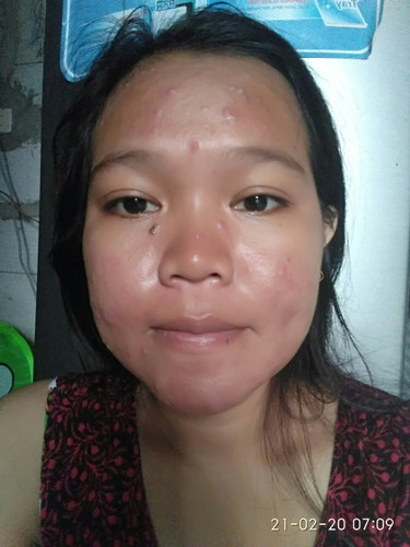 Jerawat Di Muka