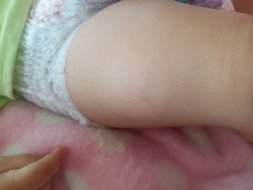 ขาบวมหลังฉีดวัคซีน