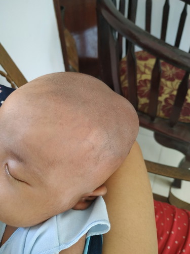 benjolan di kepala