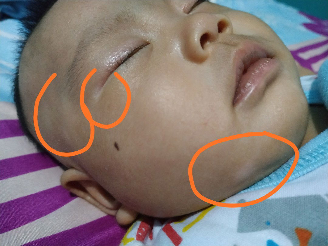 bercak putih d kulit bayi seperti panu