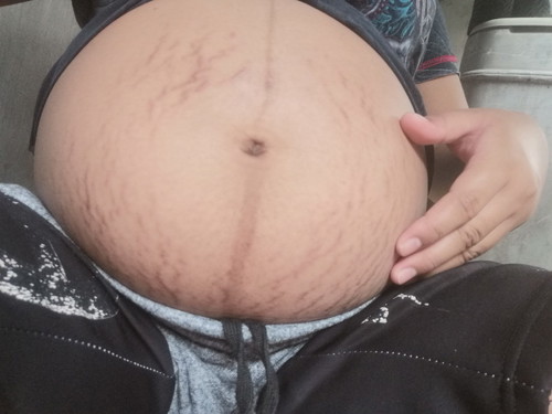 Stretch Mark!!!