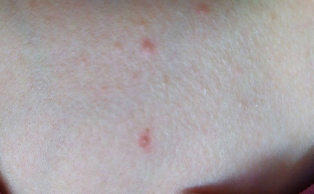 bintik merah seperti jerawat