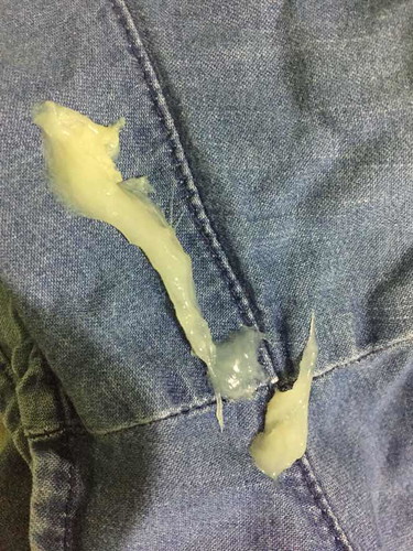 Mucus plug