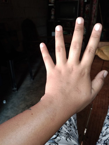 Swelling