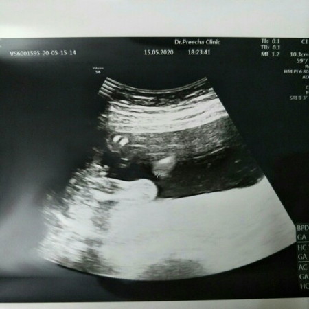 เพศลูก