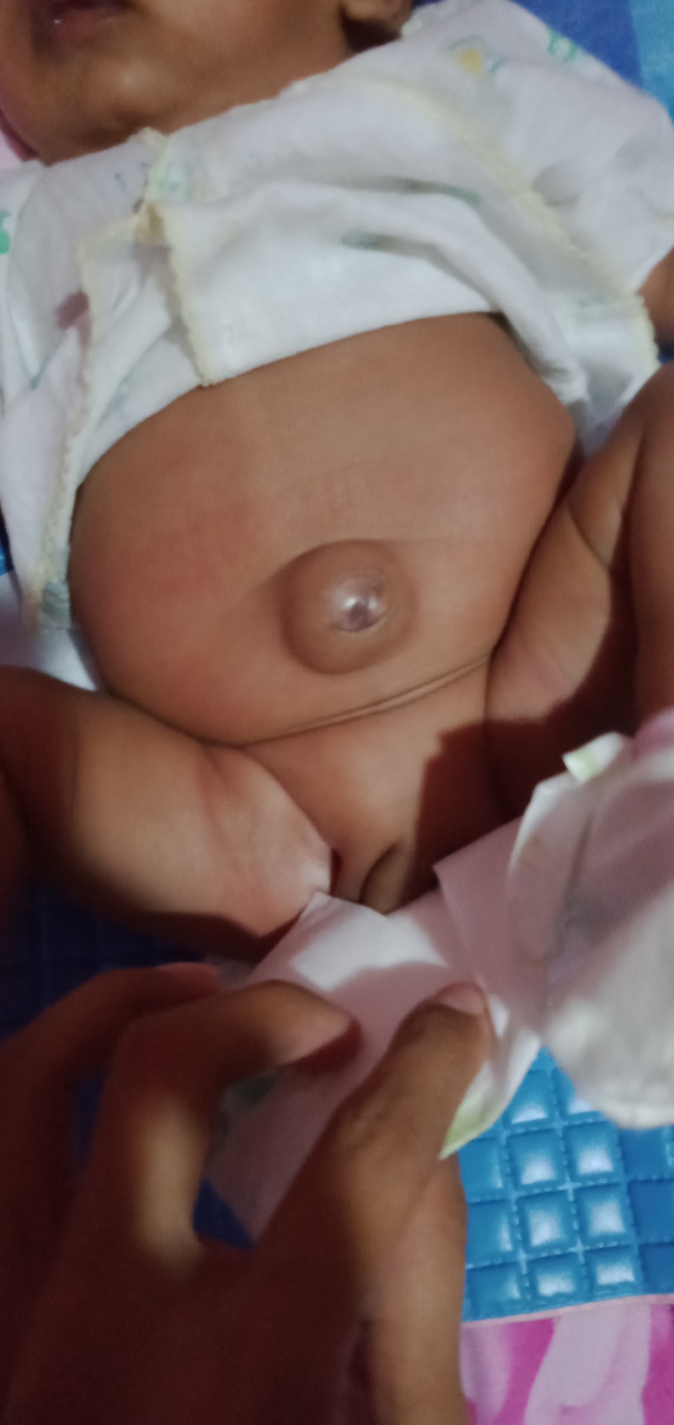 pusat bengkak atau bodong y..