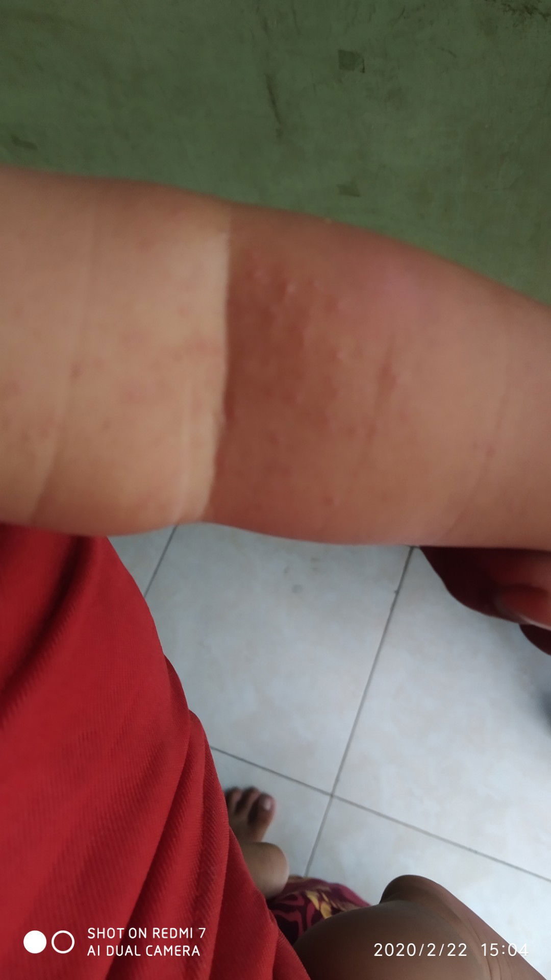 bintik merah tapi bukan biang keringat