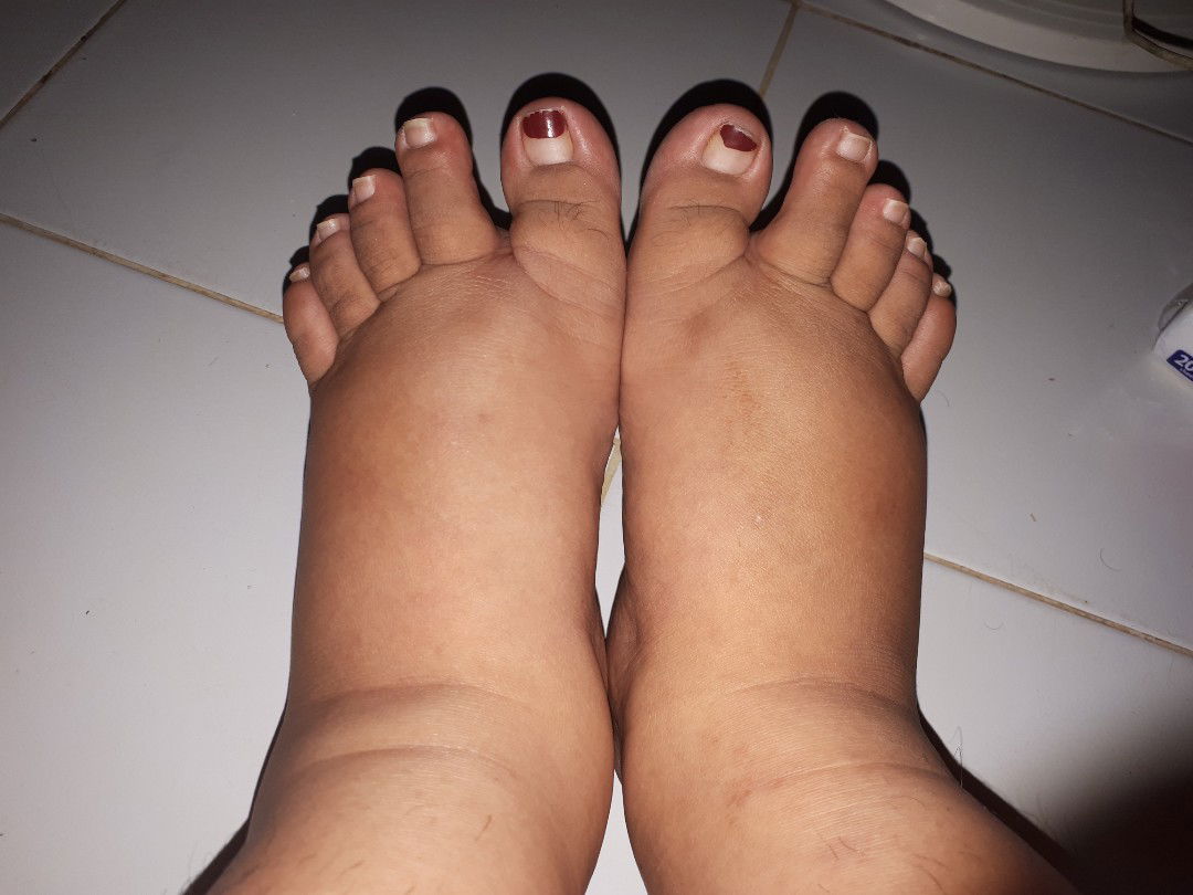 Kaki Bengkak TM3
