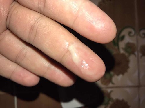 ใกล้คลอดหรือป่าวคะ มีเมือกๆแบบนี้ออกมาจากช่องคลอด