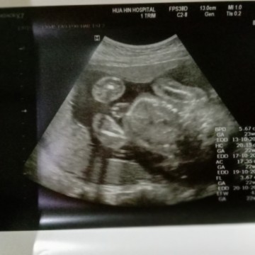 อัลตร้าซาวด์