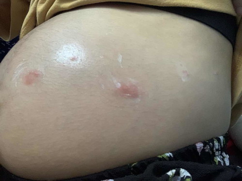 คุณแม่ท่านไหนเป็นเหมือนผื่นแดงที่ท้องไหมคะ