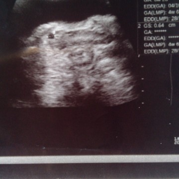 Scan 4 Weeks 6 Days