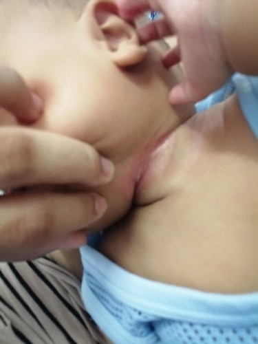 ลูกคอเปลื่อยแบบนี้เป็นไรไหมคะ