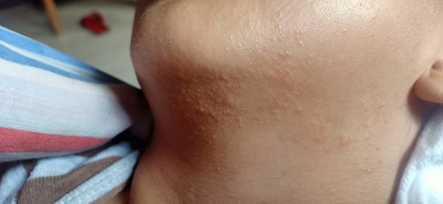 baby rashes