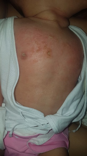 Eczema