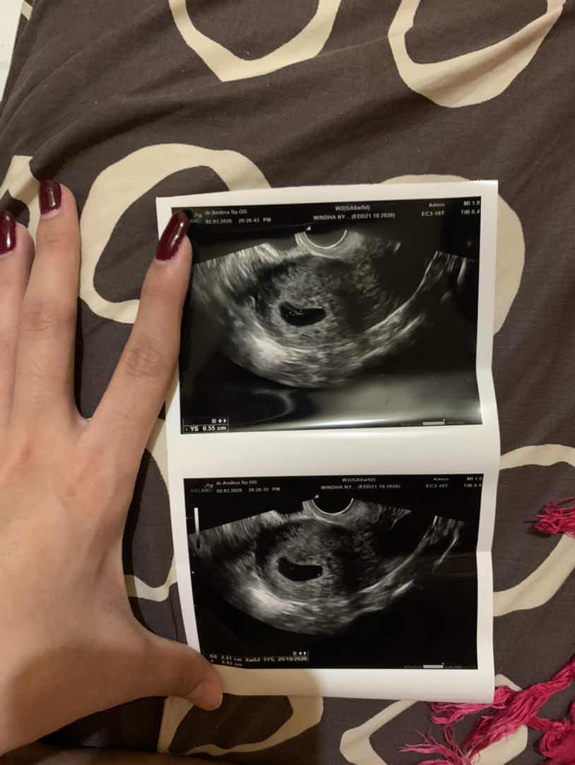 Diprediksi hamil kosong oleh dokter diusia kandungan 6 week