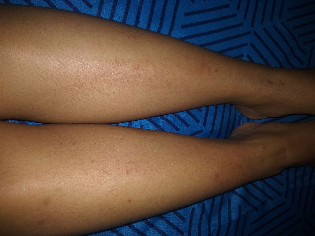 Gatal-gatal Saat Hamil