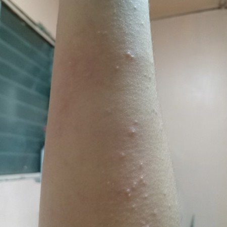 rashes