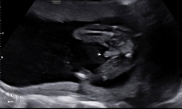 ลูกชายหรือลูกสาว