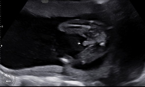 ลูกชายหรือลูกสาว