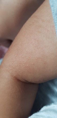 rashes