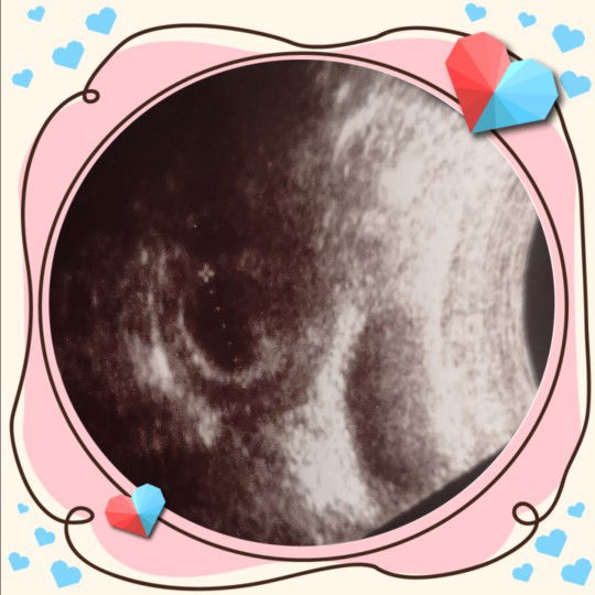 Ada Kantung Tak Nampak Janin.