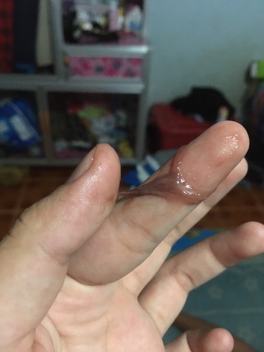 มีมูกเลือดออกขออภัยด้วยนะคะรูปภาพเป็นภาพที่ไม่ค่อยดีค่ะ