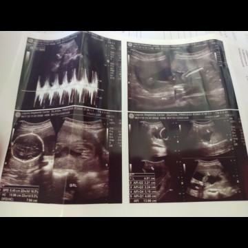 22weeks ultrasound