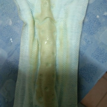 ตกขาวแบบนี้เป็นอะไรไหมค่ะ