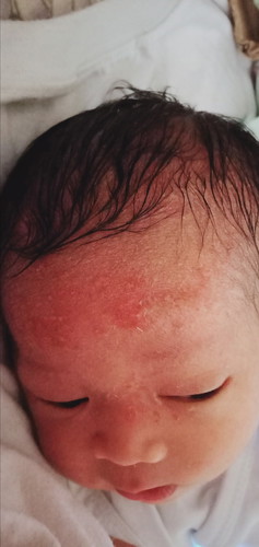 baby rashes