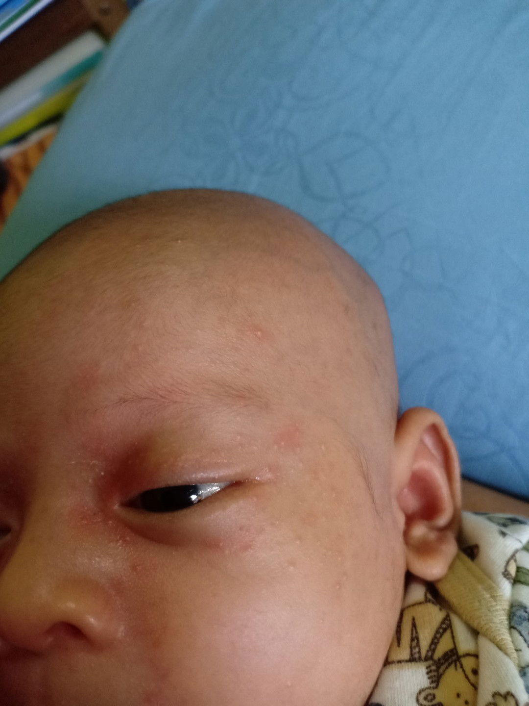 bintik-bintik kecil di muka, kepala, leher, kaki