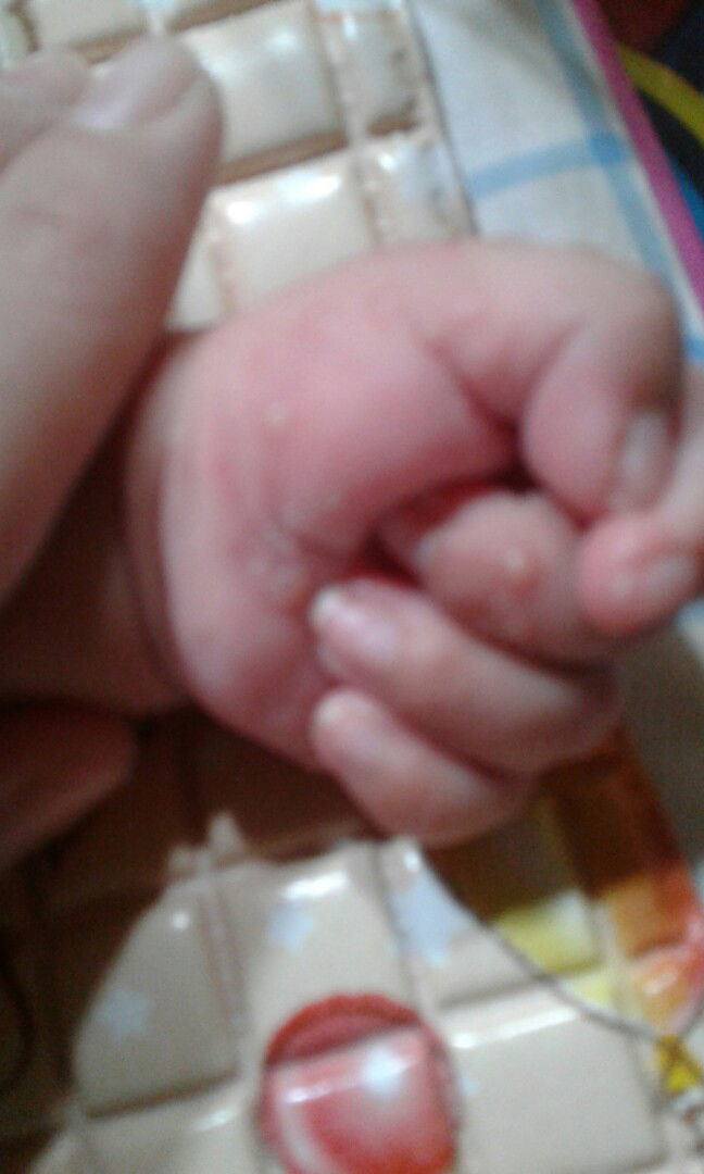 tangan bintik berair