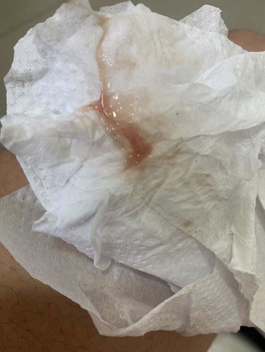 มีเลือดออก