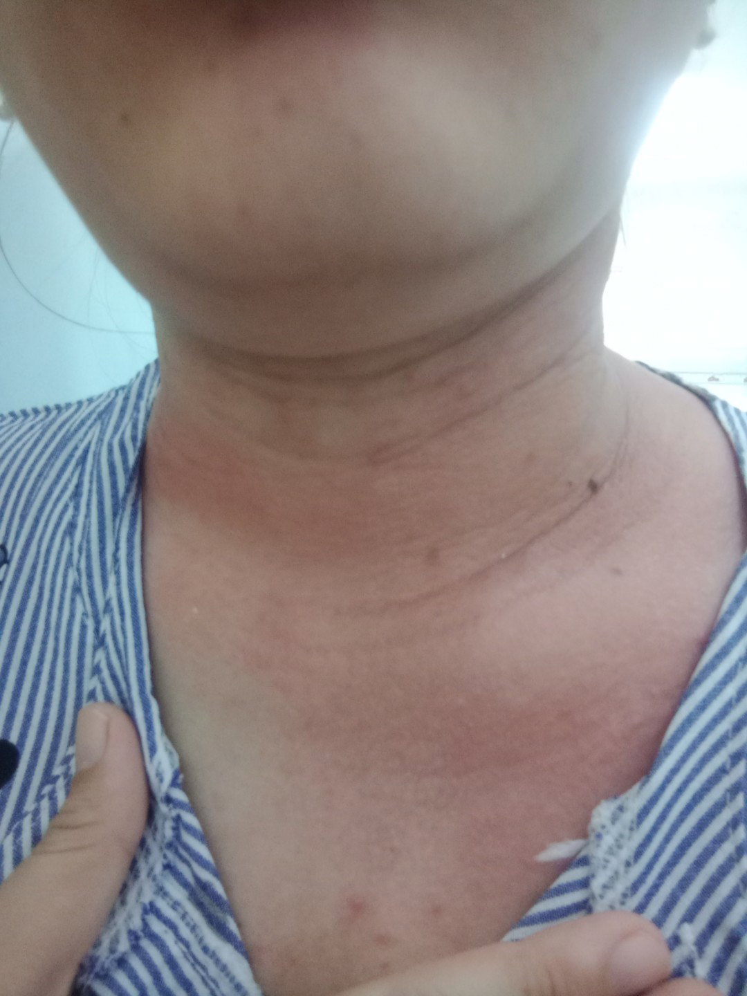 ngứa da
