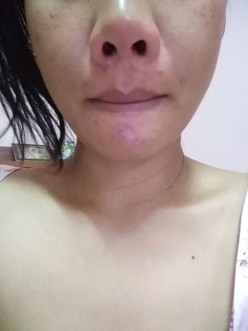 แพ้ท้อง