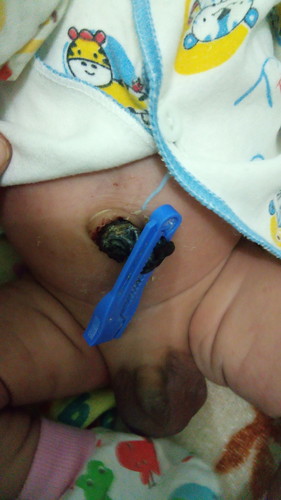 bun..tali pusar anak saya berdarah dan dia rewel...apa sakit y bun dianya karna pusarnya berdarah