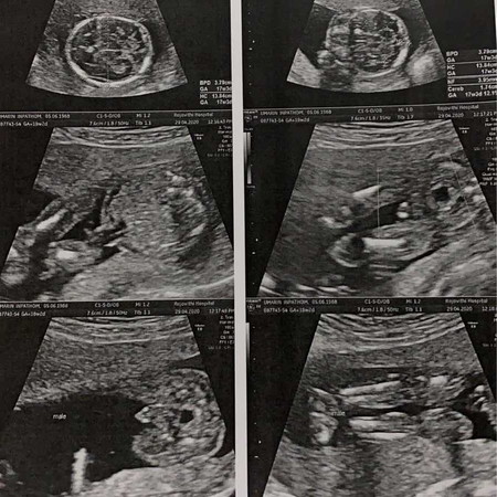 เราเป็นโรคลิ้นหัวใจรั่ว