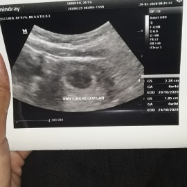 usg hri ini alhamdulillah udh memasuki 6 minggu???